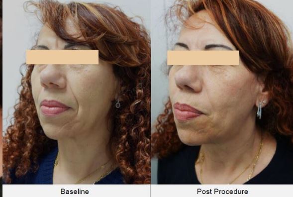 HIFU Anti-aging machine