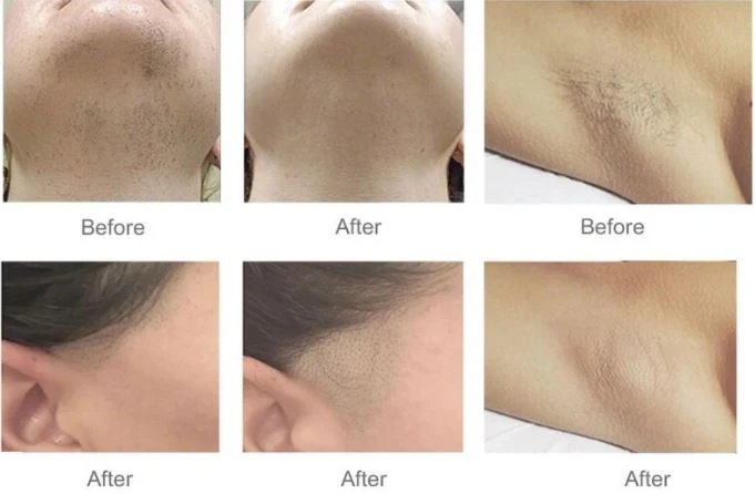 Professional Diode Laser 808nm Diode Laser Hair Removal Machine Professional Diode Laser 808nm Diode Laser Hair Removal Machine
