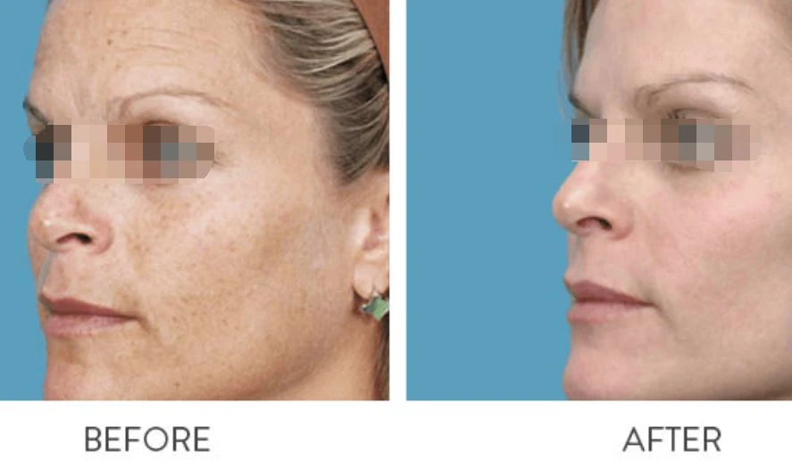 IPL skin rejuvenation